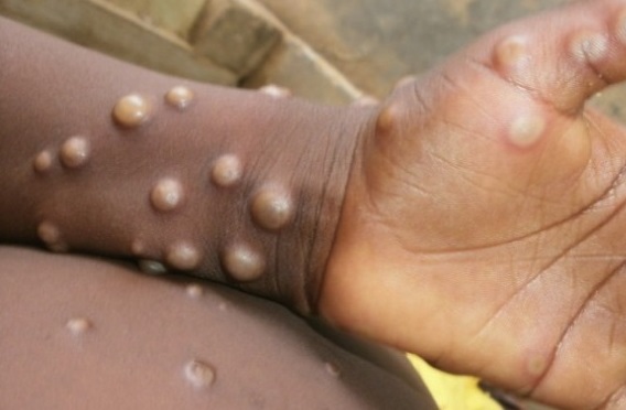 Status Monkeypox di Kaltim